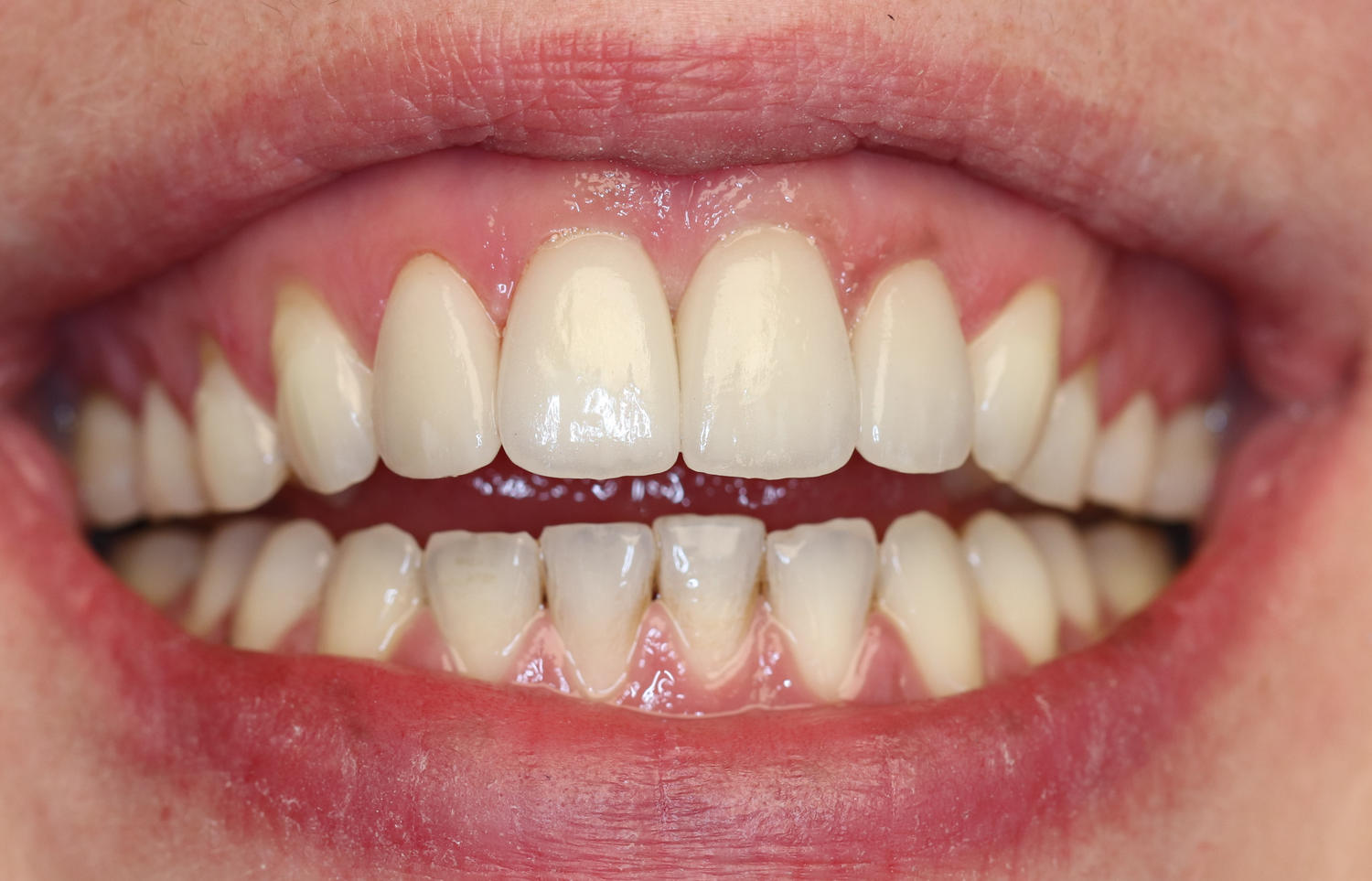 Veneers
